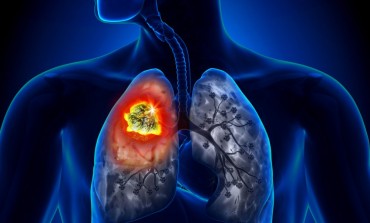 Tumore ai polmoni, tecnica di esame computerizzato raggiunge maggiore accuratezza