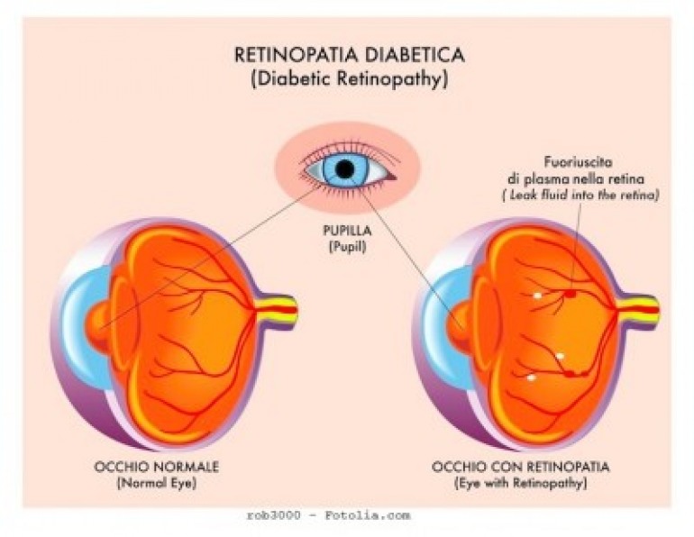 Isernia, giornata mondiale della vista: seminario sulla retinopatia diabetica